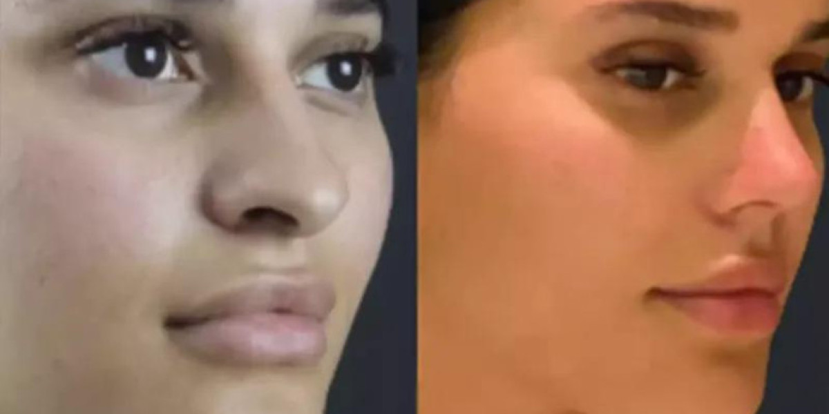 Rhinoplasty in Dubai: Choosing the Right Procedure for Your Nose Shape