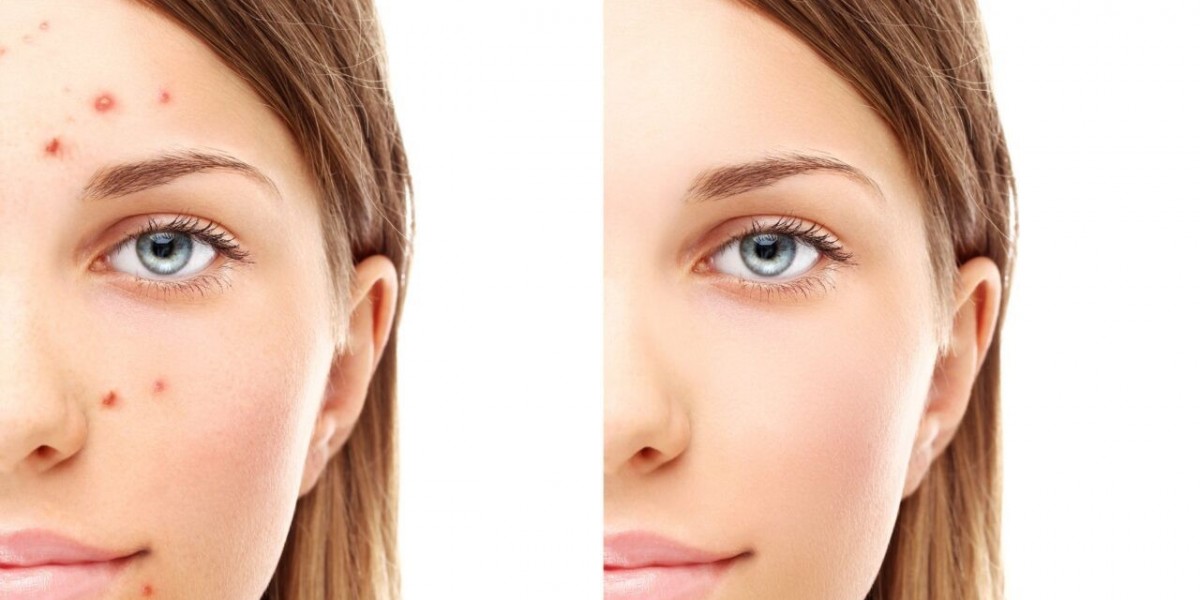 The Natural Solution Your Skin Has Been Waiting For: A Deep Dive Into Hypochlorous Acid for Acne