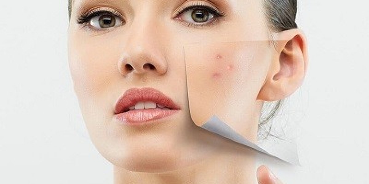 Can men and women undergo the same acne scar treatments?