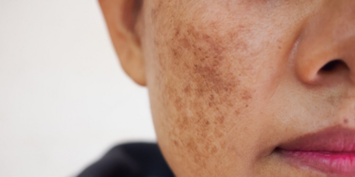 Is Melasma Curable? Debunking Common Myths in Islamabad