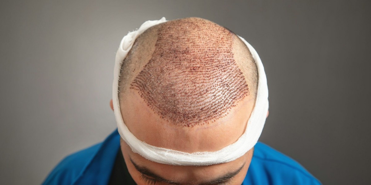 Can I get a hair transplant if I have a medical condition?