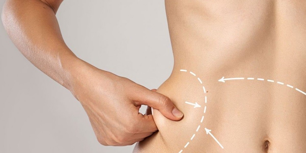 Understanding Liposuction Cost in Islamabad
