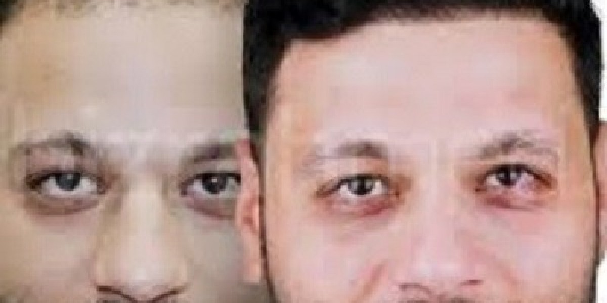 Meet Riyadh’s Leading Hair Transplant Surgeons
