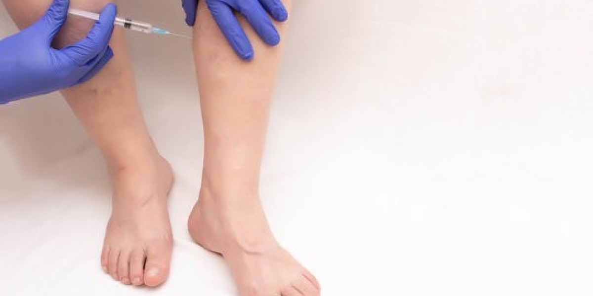 “The Science Behind Spider Veins Treatment in Islamabad”