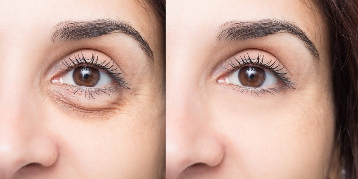 Combining Treatments for Effective Dark Circles Reduction in Islamabad