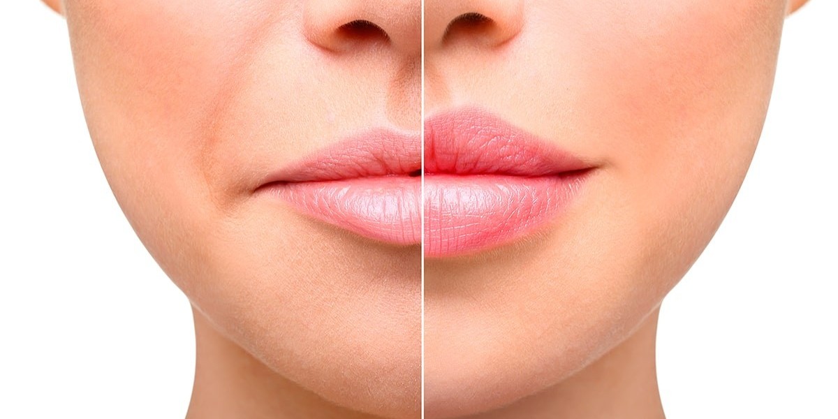 How Age Affects Lip Augmentation Results