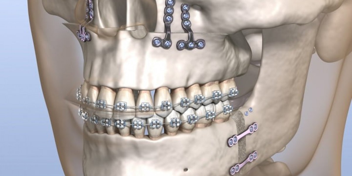 How Jaw Surgery Can Help Correct Bite Issues in Islamabad