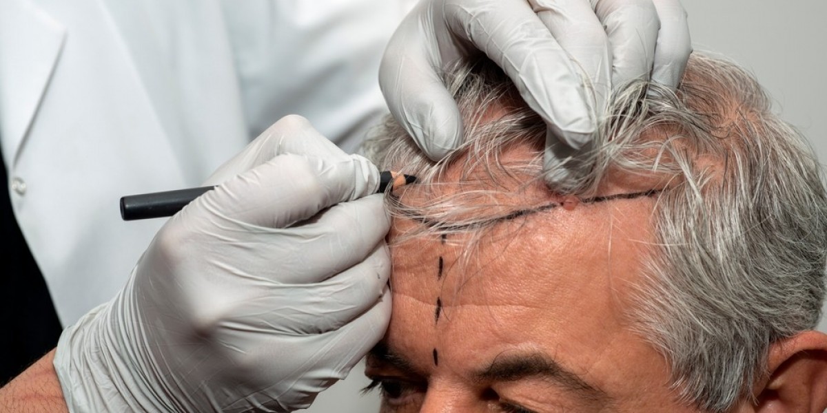 How Long Does It Take to See Results After Hair Transplant?