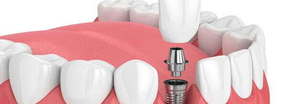 Guide to Dental Implants Profile Picture